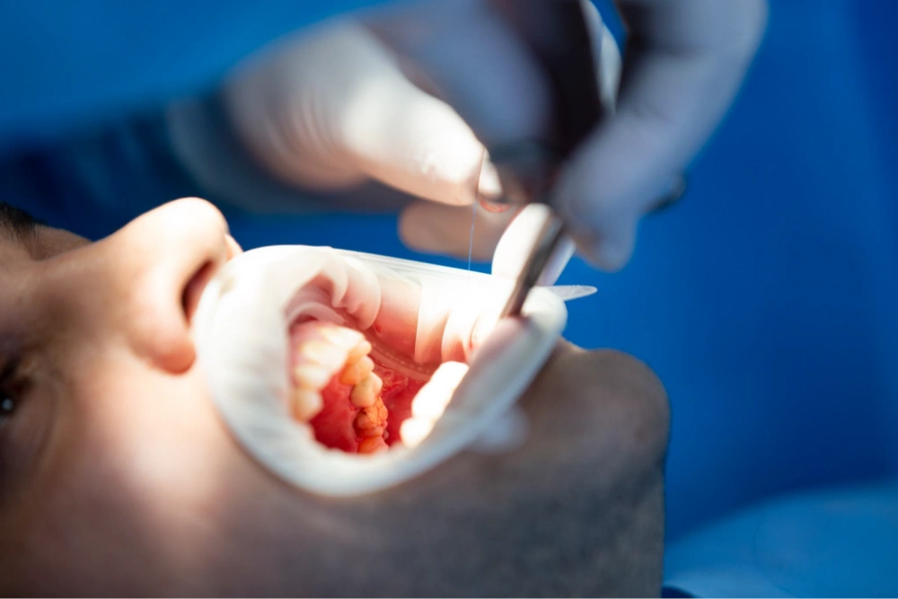 Mengenal Bone Graft dan Membran: Fondasi Kokoh di Balik Implan Gigi