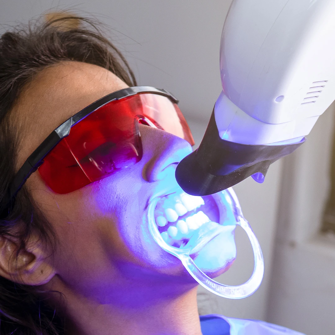 Whitening