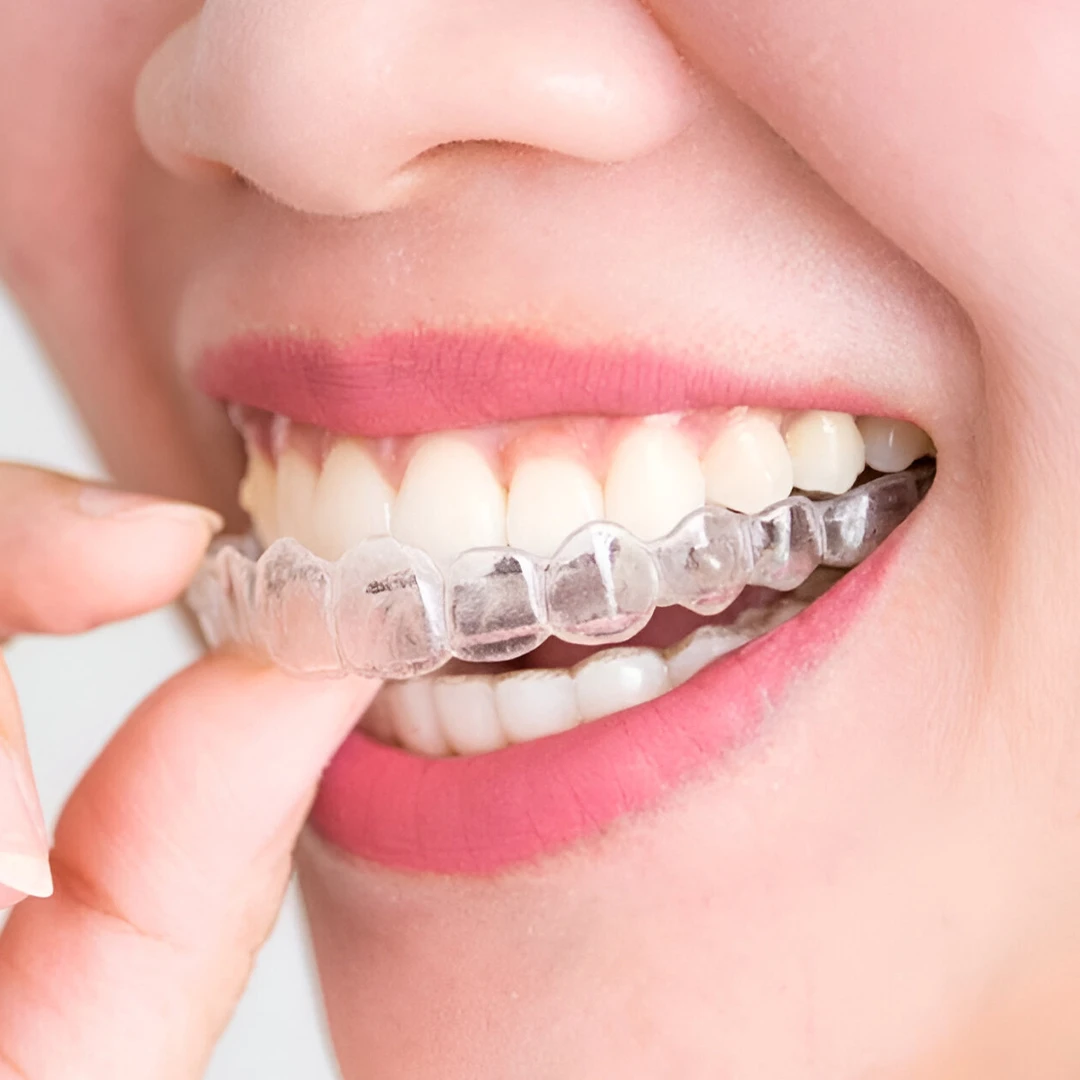Clear Aligner